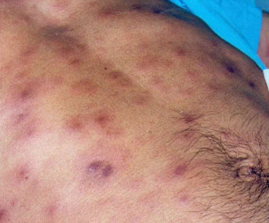 Maladies sexuellement transmissibles